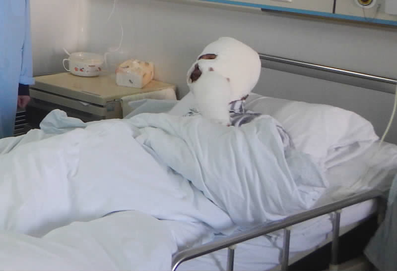 朱达被烧伤后全身裹着纱布,躺在无菌病房内.