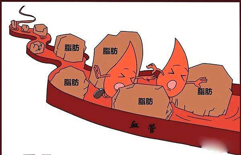 血管堵致器官缺血或猝死